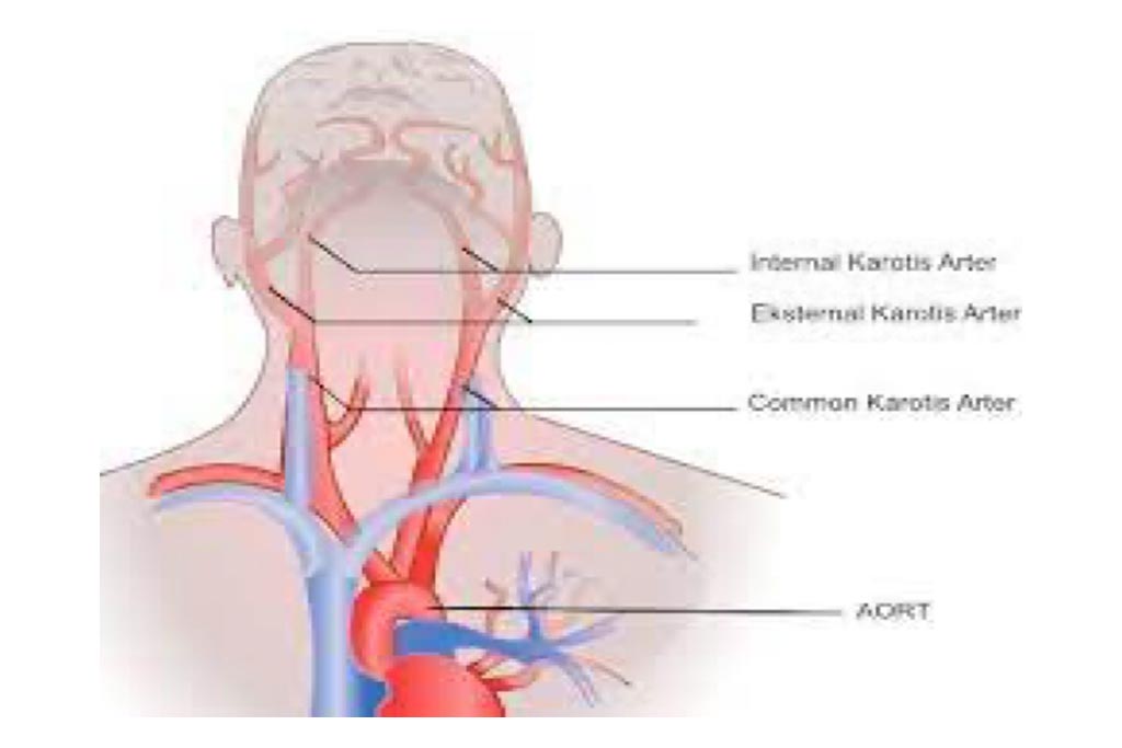 Carotid Artery Stenting